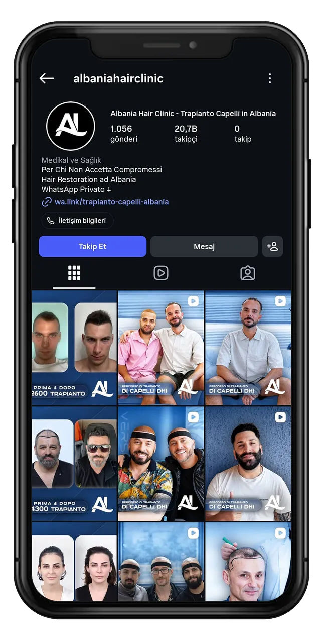 Albania Hair Clinic — Instagram